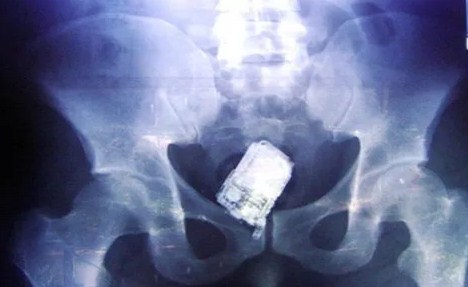 الصحة تكشف حقيقة نسيان هاتف خلوي