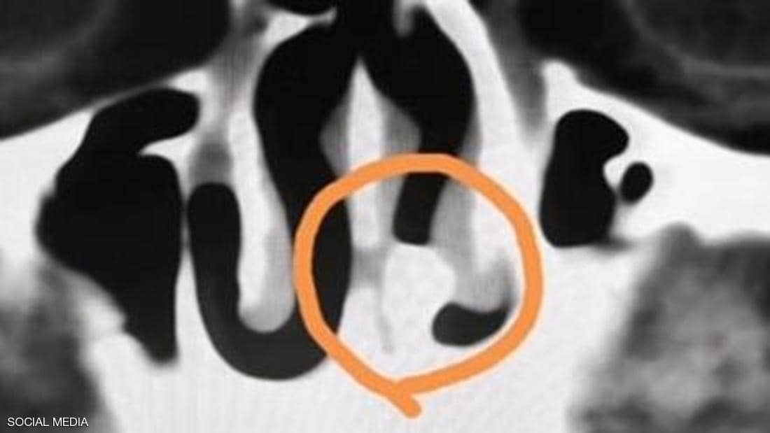 عاش 20 عاما بانسداد في الأنف