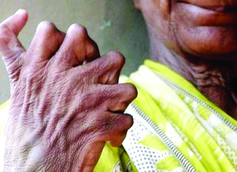 التنمر يحوّل حياة «ذات الأصابع» إلى