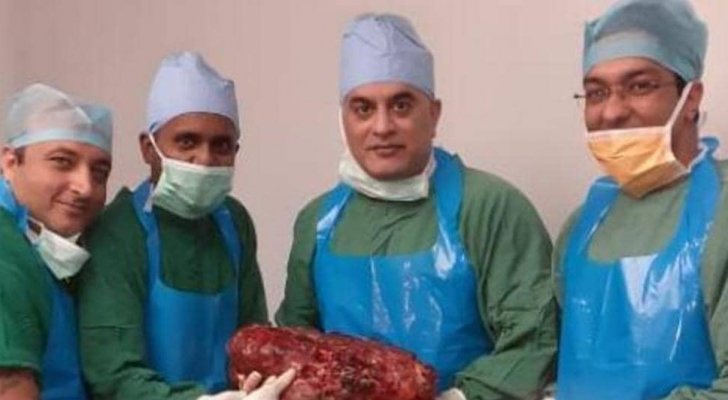 استئصال كلية يعادل وزنها مولودين اثنين