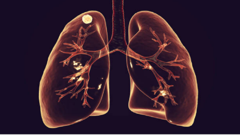 علامات في اليدين قد ترتبط بسرطان