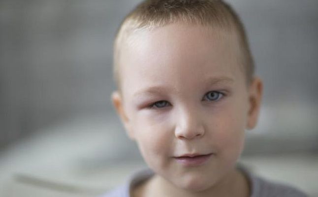 5 أسباب لانتفاخ العينين في الصباح