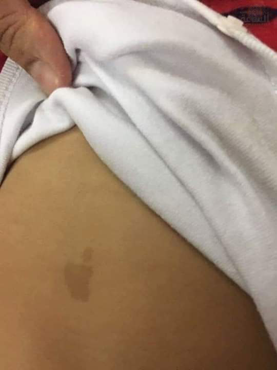 بالصورة.. ظهور وحمة غريبة على بطن