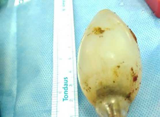 ظلّت في بطنه 11 عاما.. استخراج