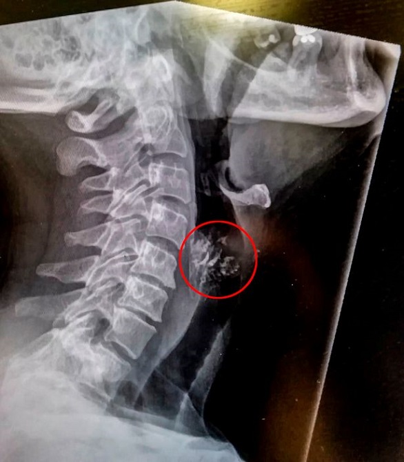 تحصل على لسان جديد بعد مرضها