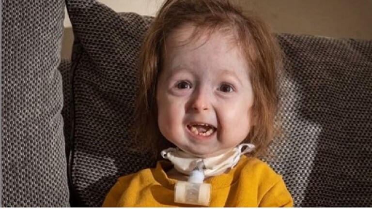 تغيرات فريدة تحول طفلة بعمر سنتين