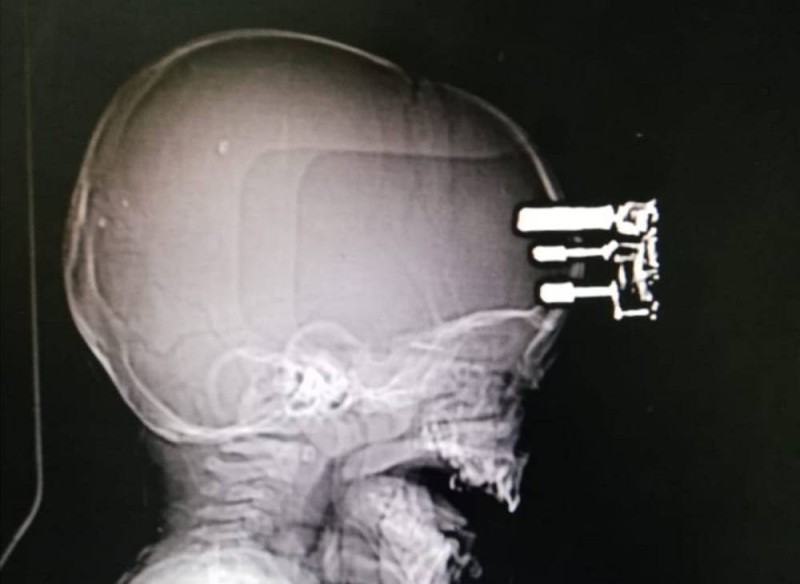 شاحن جوال يخترق رأس طفل