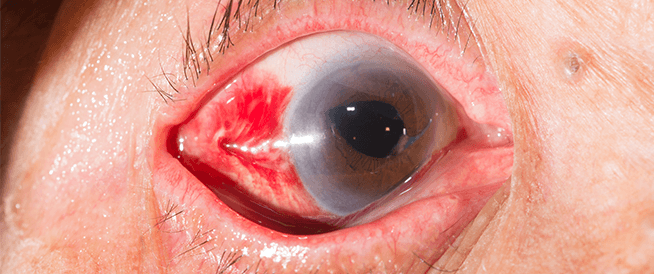 والعين أيضا تصاب بالجلطة إليكم :