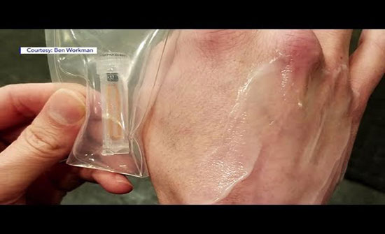 يزرع شريحة في يده لفتح وإغلاق