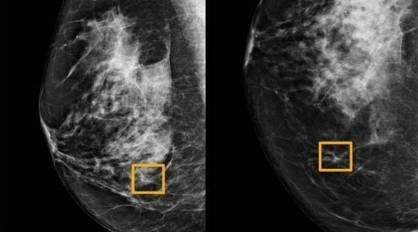 غوغل يكتشف سرطان الثدي.. بدقة