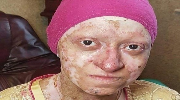 تعاني من حالة نادرة تغطي جسمها