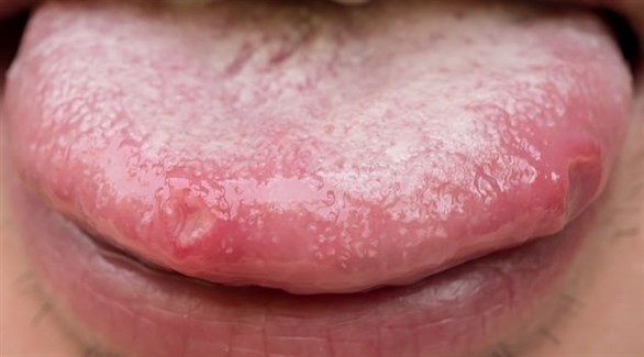 اللسان السمين.. سبب جدبد للشخير