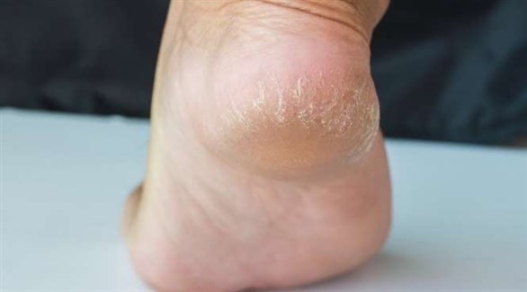 علاجات طبيعية لتشقق الكعبين أثبتت فاعليتها