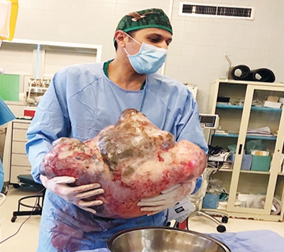 استئصال ورم يزن 33 كيلوغراما من