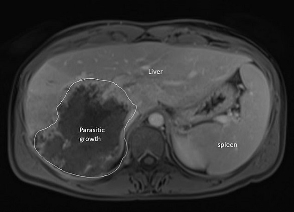 تكتشف أن ورمها غير سرطاني بعد