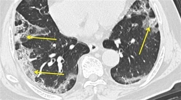 خبراء: هذا ما يحدث لرئة المصاب