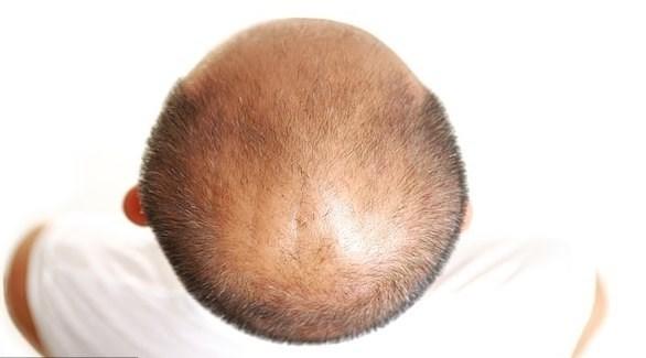 الصلع يزيد احتمال نقل مرضى كورونا