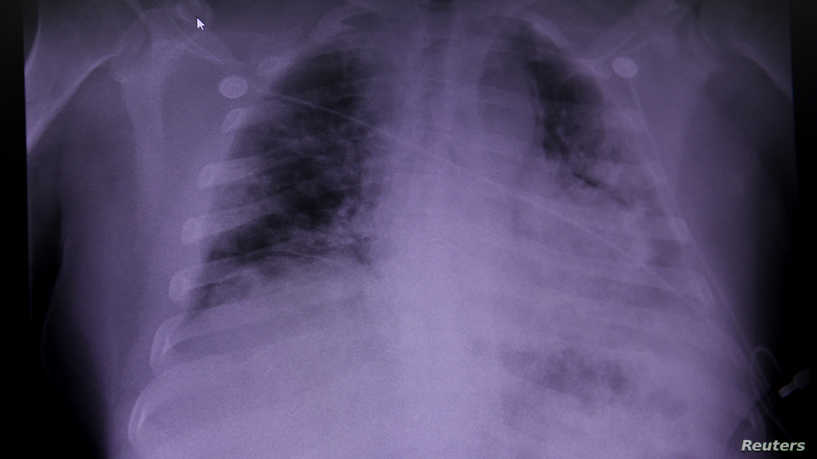 آثار كورونا في جسم المتعافين تثير