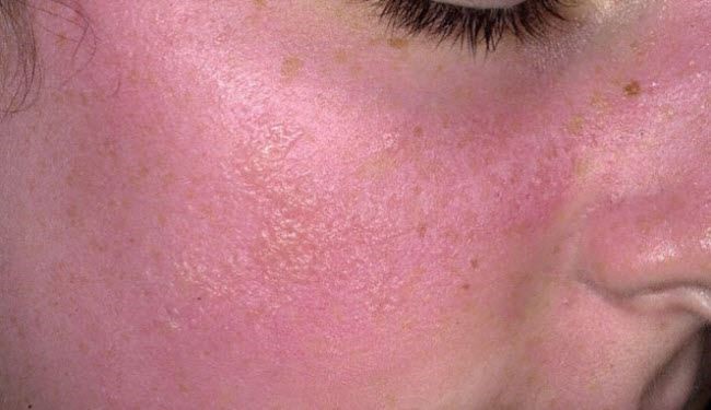 حروق الشمس.. المضاعفات الخطيرة وطرق الوقاية