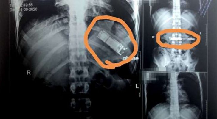 العثور على هاتف محمول في معدة