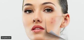 أطعمة تسبب .. . وتزيل حب