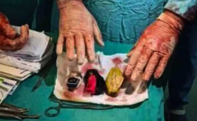 فريق طبي يستخرج: هاتف محمول وولاعة