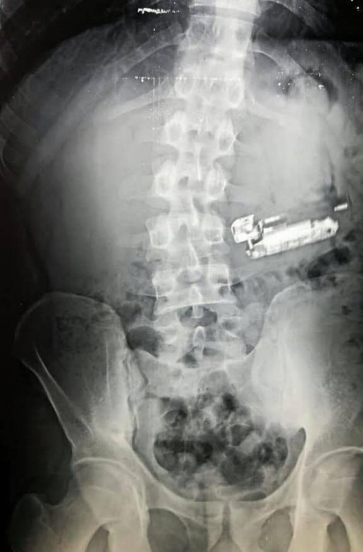 استخراج جوال وولاعة وعملات من بطن