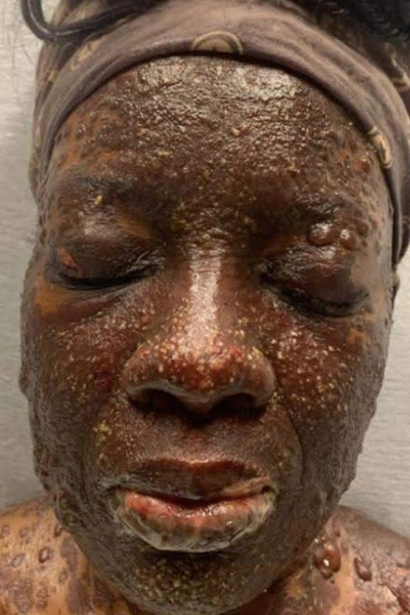 دواء لعلاج الأذن يتسبب لها بحساسية