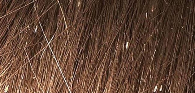 كيف تتخلصين من القشرة بسرعة وبطريقة