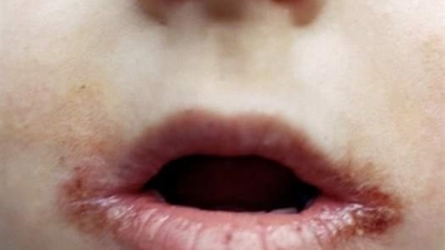 تشقق زوايا الفم مؤشر على الإصابة