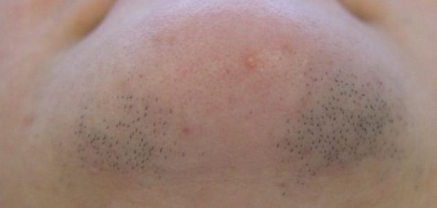 أسباب ظهور الشعر في الذقن لدى