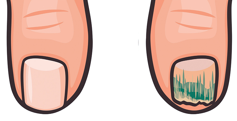 فطريات الأظافر.. مرضى السكري وضعف الجهاز