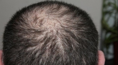 بعض أدوية تساقط الشعر قد تزيد