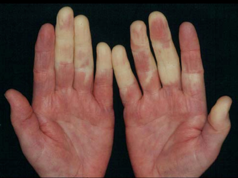 معلومات مهمة لمن يصاب بمرض رينود