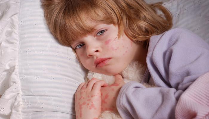 عدوى الداء الخامس لدى الأطفال.. انتبه