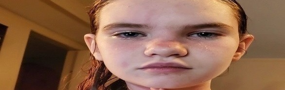 تعاني من حساسية تجاه الماء تهدد