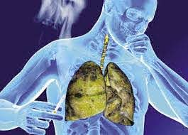 كورونا يقوض جهود القضاء على السل