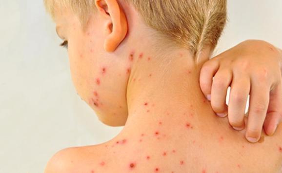 كيف تسبب كوفيد-19 في تفشي الحصبة؟