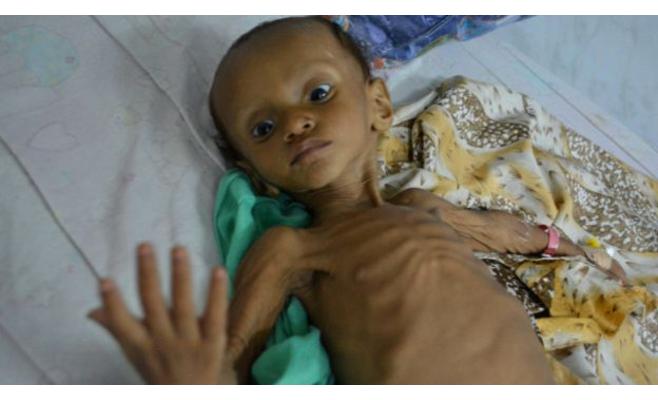 34 وفاة بالكوليرا والاشتباه بألفي إصابة