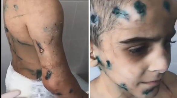 بتر ذراع طفلة بسبب تعرضها للضرب