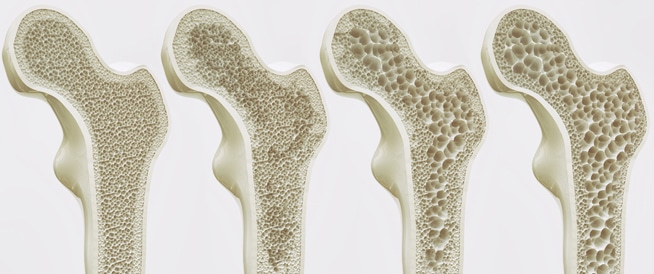 مرضى هشاشة العظام أكثر عرضة لكسر