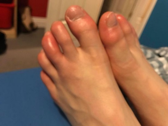 أعراض غريبة لكورونا تمنع طفلا من