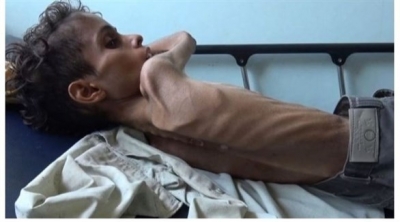 وزنه 7 كيلوغرامات فقط.. الجوع ينهش