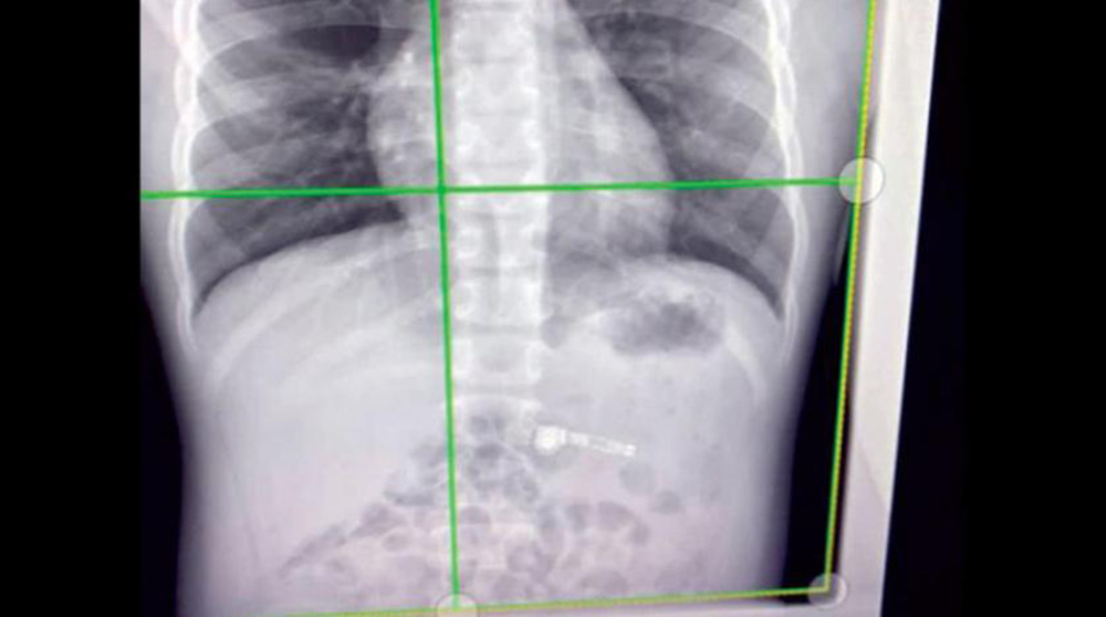 أفاق مختنقا وفي المستشفى اكتشف صدمة