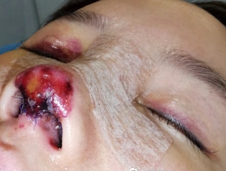 تصاب بتعفن في أنفها بعد عملية