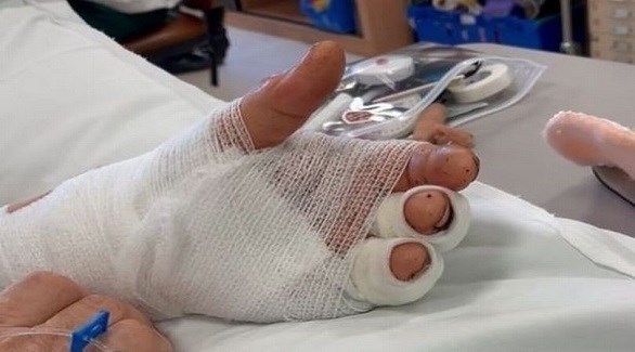 أطباء يعيدون وصل يد مريض في