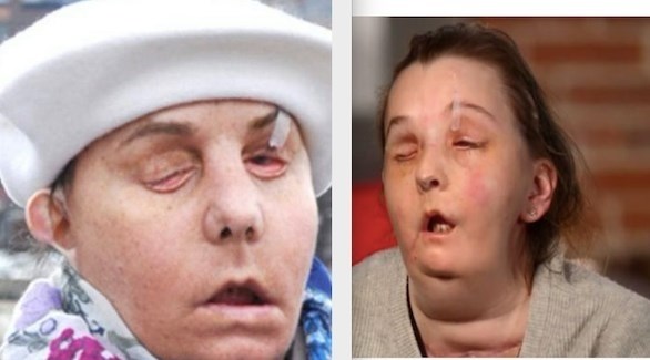 أول امرأة في العالم تخضع لزراعة