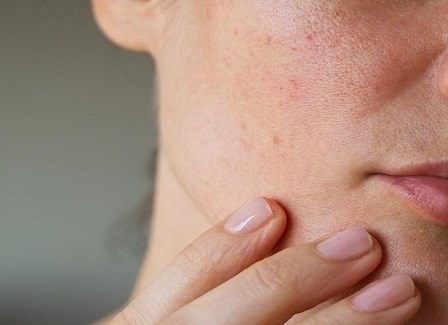 كيف تتخلصين من توسع مسام البشرة