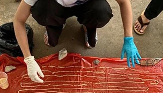 إخراج دودة من معدة مريض بطول