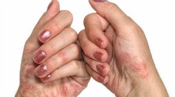 الصحة العالمية: الباحثون يدرسون البنغول بجانب